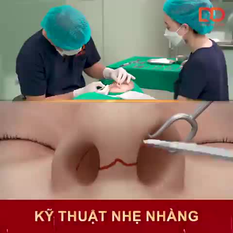 LÀM SAO ĐỂ SAU KHI NÂNG MŨI CÓ: "GÓC CHÍNH DIỆN ĐẸP XINH, GÓC NGHIÊNG MỀM MẠI"