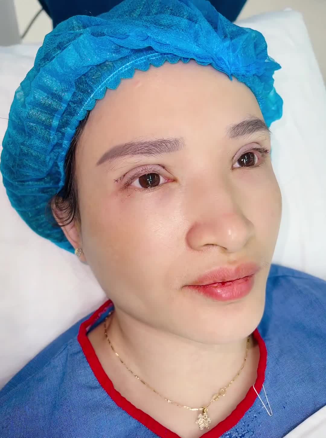 Kết quả CẮT MÍ sau 30 phút tiểu phẫu đây ạ!