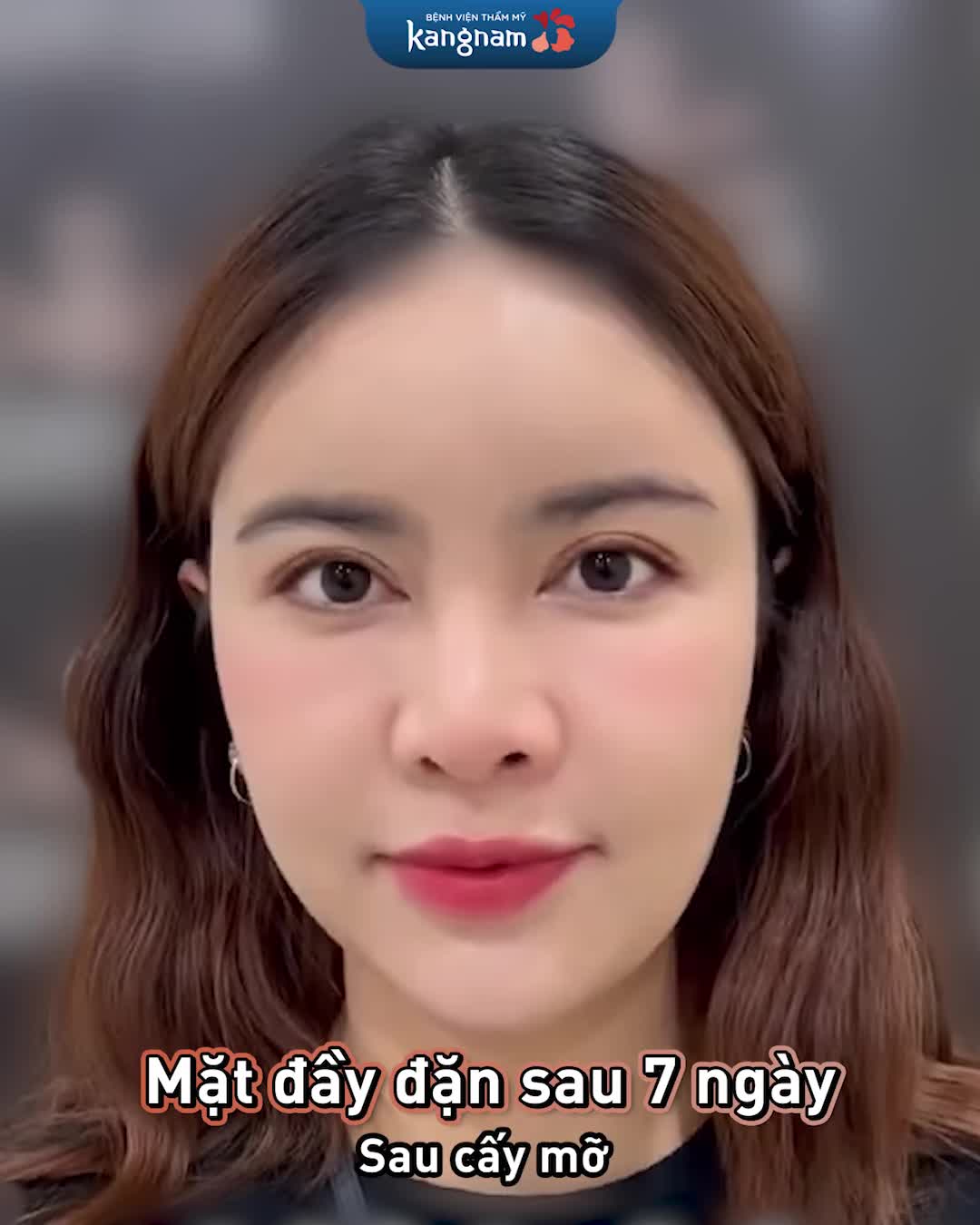 Wow! Nhìn là mê chị khách hàng cấy mỡ xong trẻ ra vài tuổi