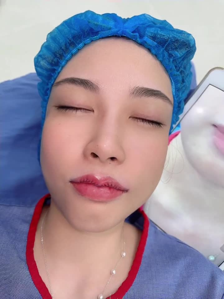 Kết quả tạo hình môi tim siêu đẹp tại Kangnam Hà Nội ạ!