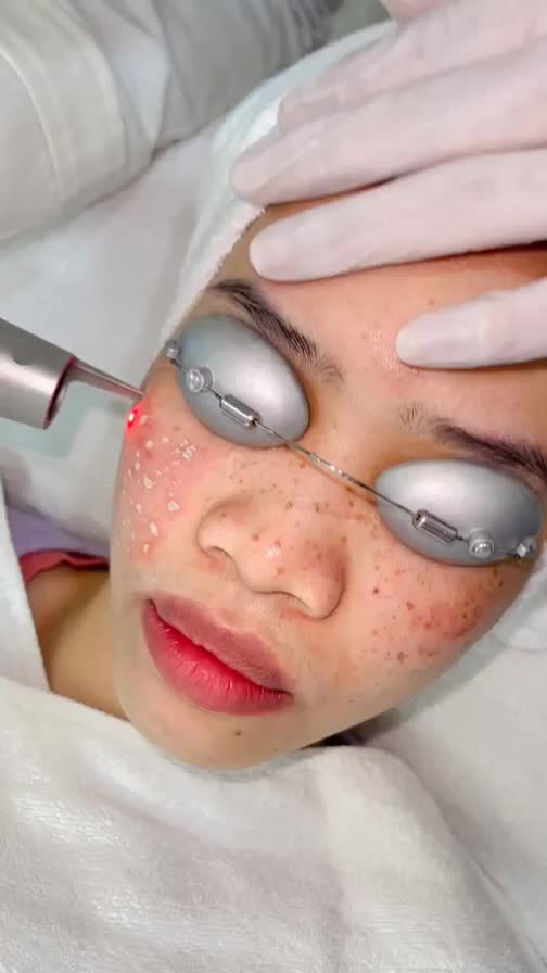Điều trị tàn nhang nổi rõ khắp mặt với Laser Picosure