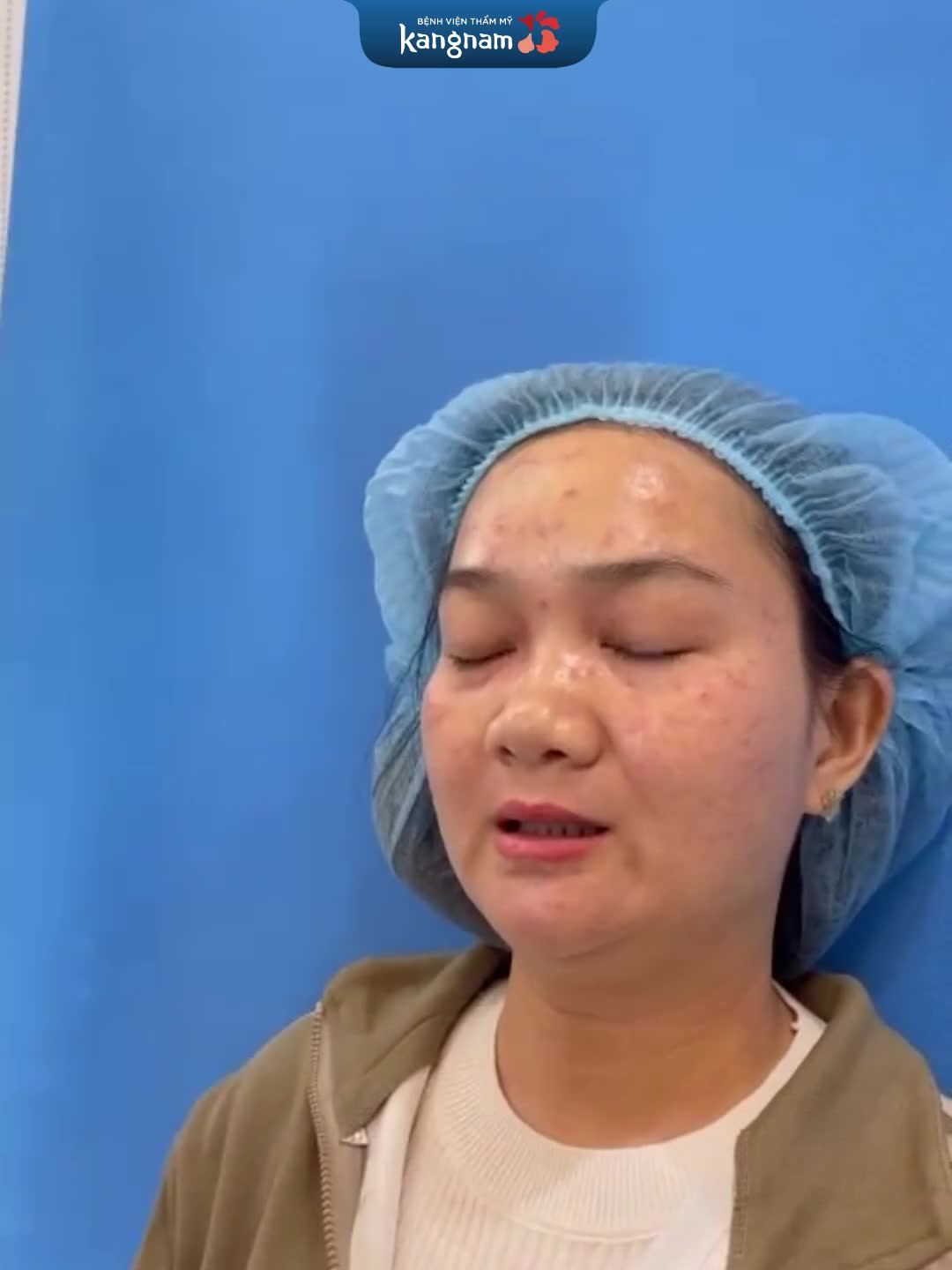 Trị tàn nhang với Laser Picosure xong cần chăm sóc như thế nào?