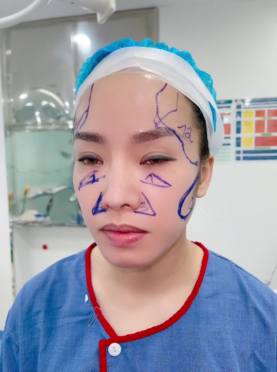 Liên tiếp những ca làm đẹp trực tiếp ngay phòng phẫu thuật cho cả nhà chiêm ngưỡng!