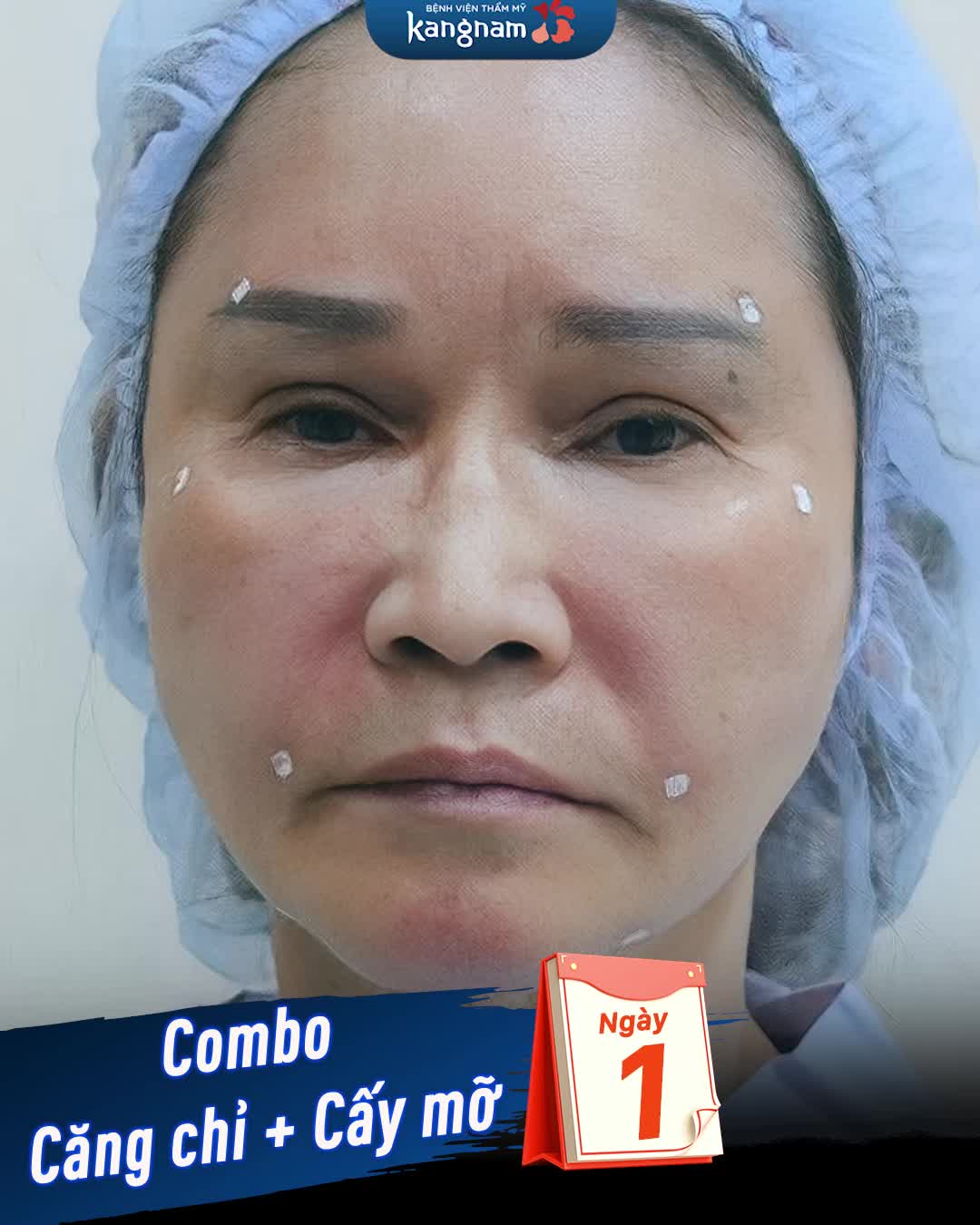 "Lột xác" trẻ trung với combo: Căng chỉ + Cấy mỡ