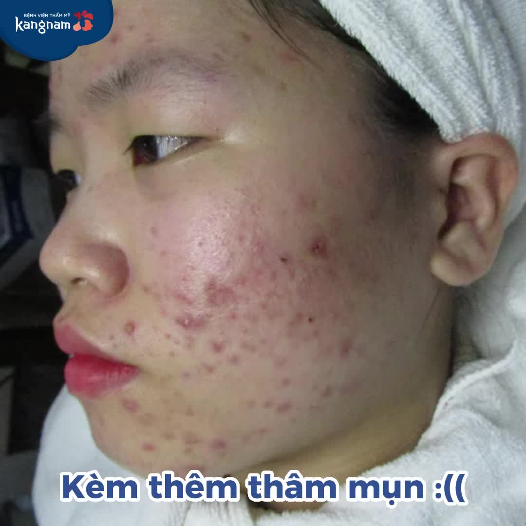 Thoát khỏi cơn "ác mộng" MỤN sau 4 buổi điều trị