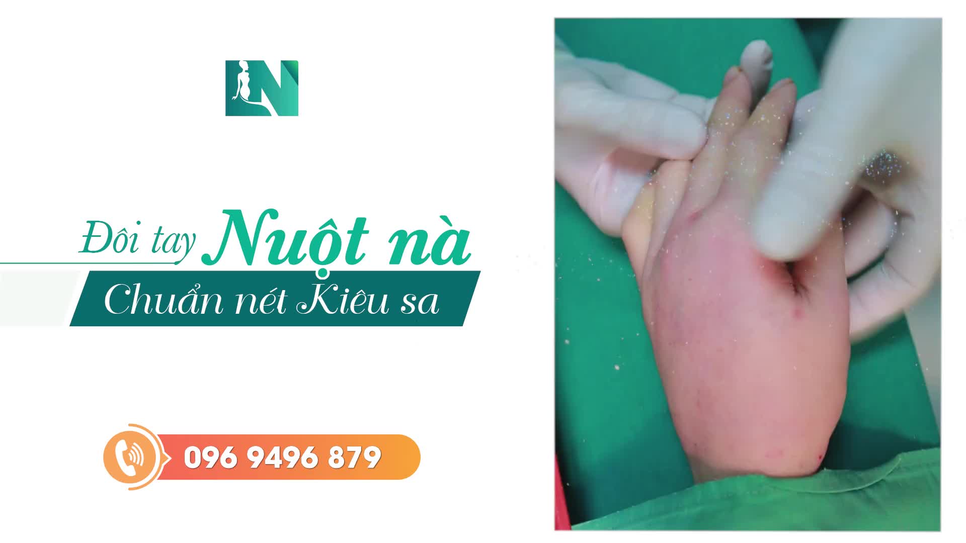 Cấy mỡ trẻ hoá bàn tay là giải pháp sử dụng mỡ tự thân để cải thiện: Đôi tay da nhăn nheo, ngón tay gầy guộc, thô ráp trở nên mịn màng, ngón tay thon nuột, nữ tính – chỉ sau 45 phút.