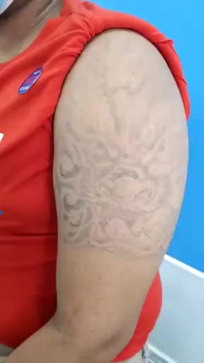 Xóa xăm Picosure có hiệu quả như lời đồn?
