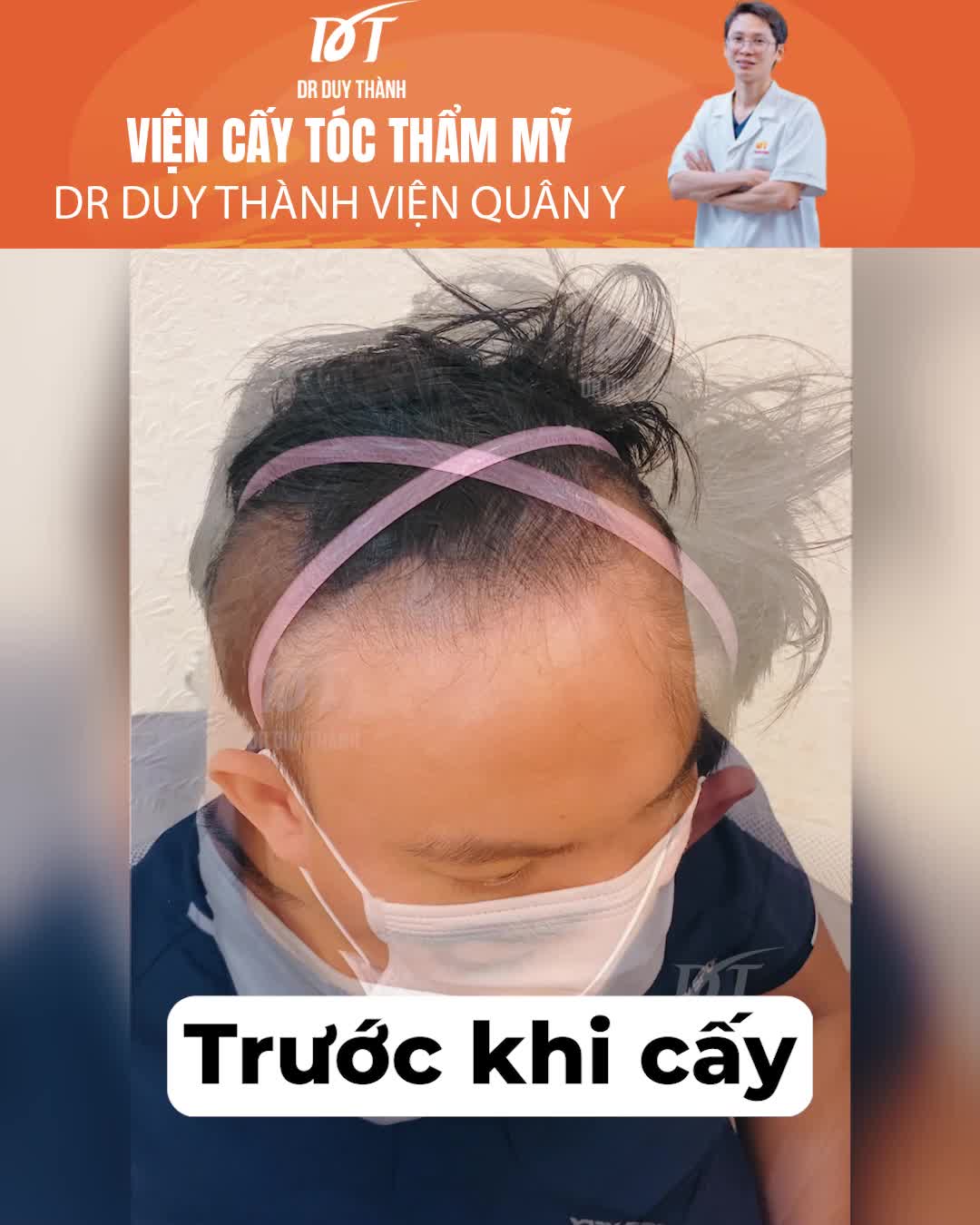 Cấy 2000 nang tóc sau 6 tháng sẽ như thế nào ?