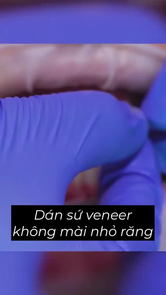 Cận cảnh quy trình Dán sứ tại Jun Dental