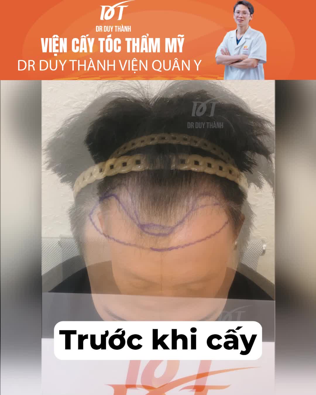 Hết hói chữ M sau cấy 1800 tóc tại Dr Duy Thành - chiêm ngưỡng kết quả sau 6 tháng