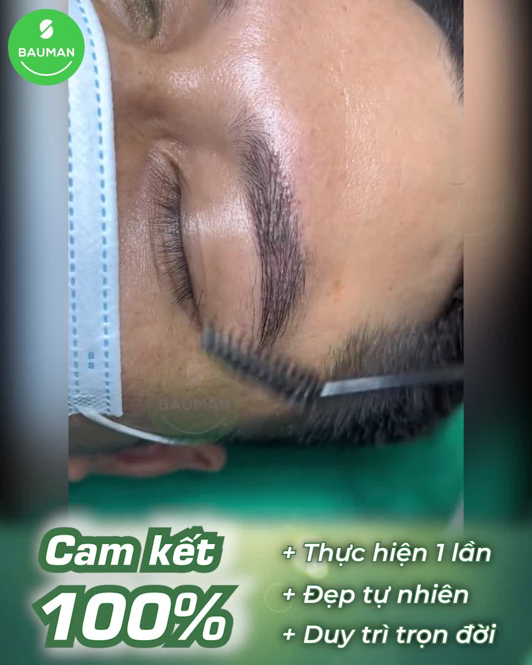 Khách hàng nam có ngay bộ lông mày đen rậm sau cấy