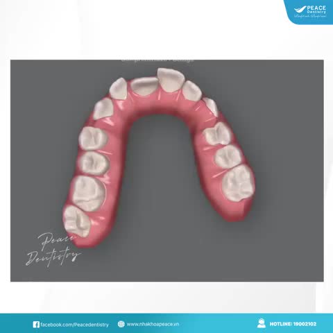 ​​​​​​​Clincheck trong chỉnh nha invisalign