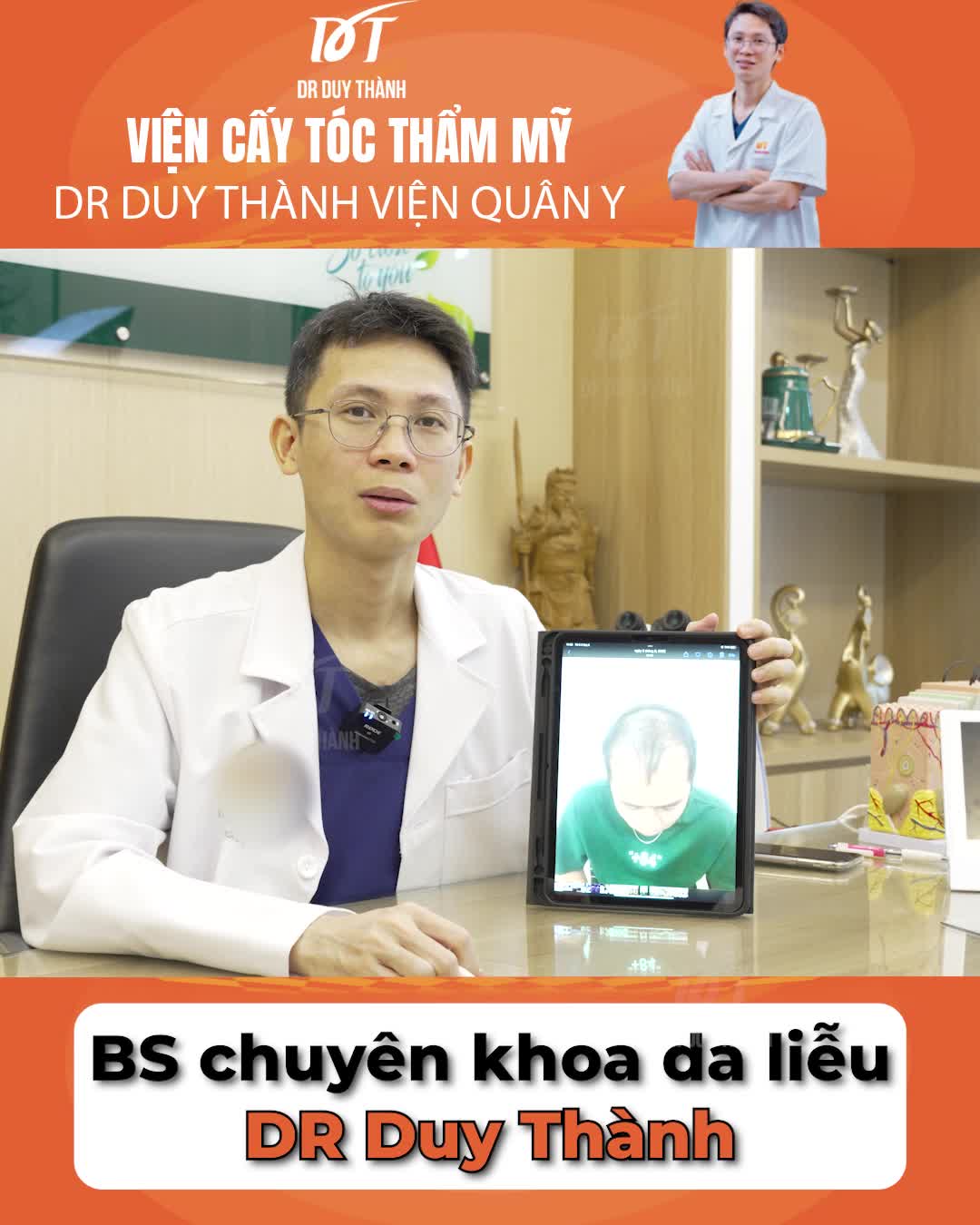 Tóc yếu có cấy tóc được không? Dr Duy Thành phân tích trên khách hàng thực tế