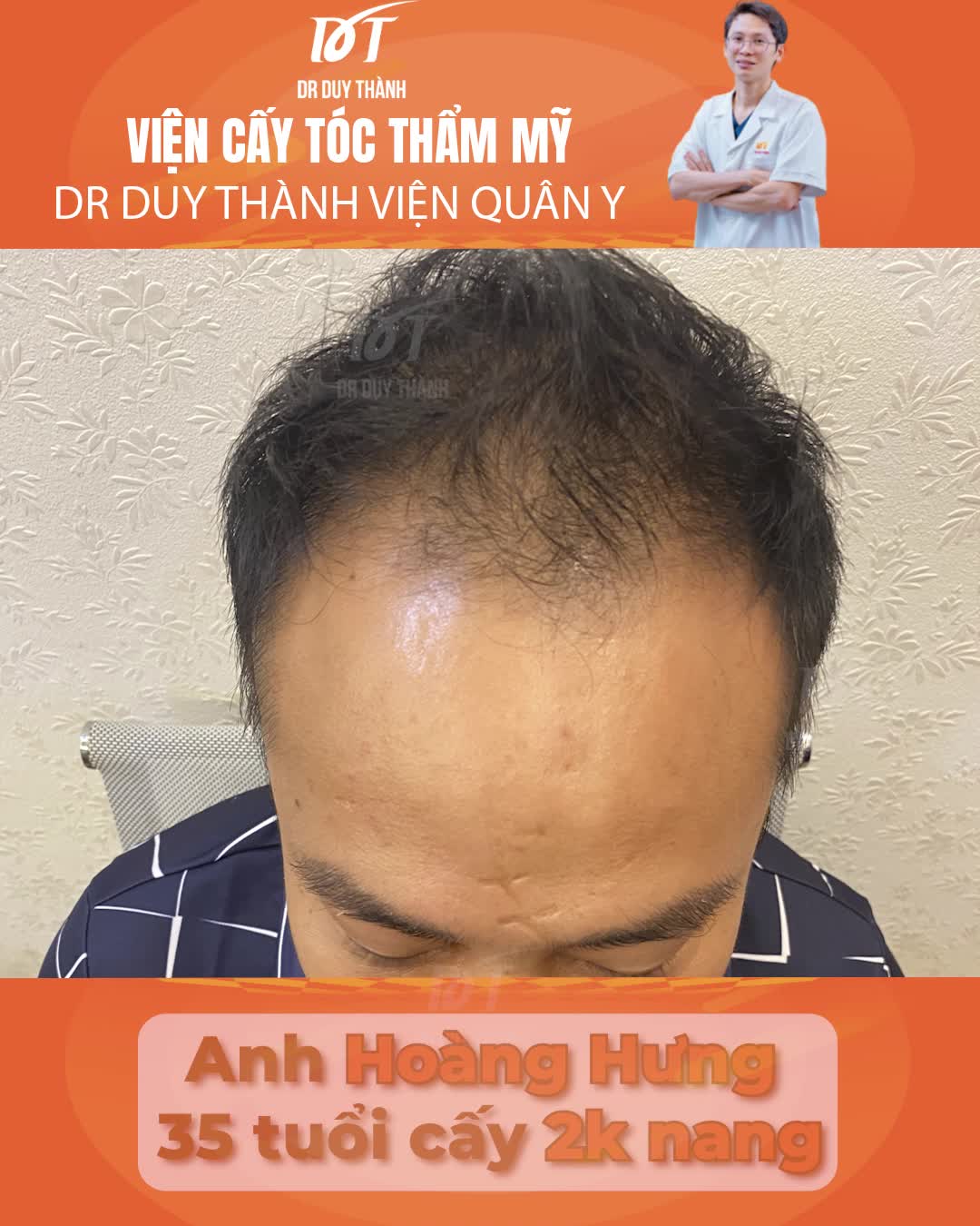 Các bạn mà bị rụng tóc hói đầu thì chúng ta nên đi chữa sớm - chia sẻ của boy thoát hói