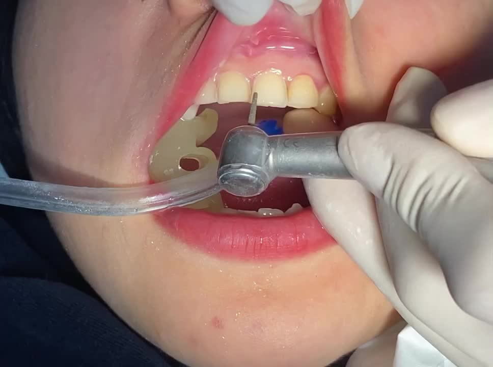 Dán sứ cho chị khách vào chiều thứ 7