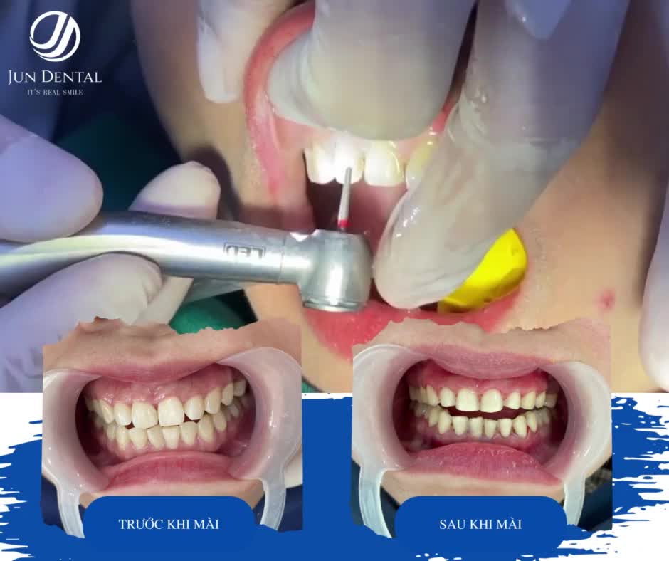 DÁN SỨ VENEER KHÔNG MÀI NHỎ RĂNG THẬT CHO KHÁCH HÀNG TRẦN HẢI YẾN