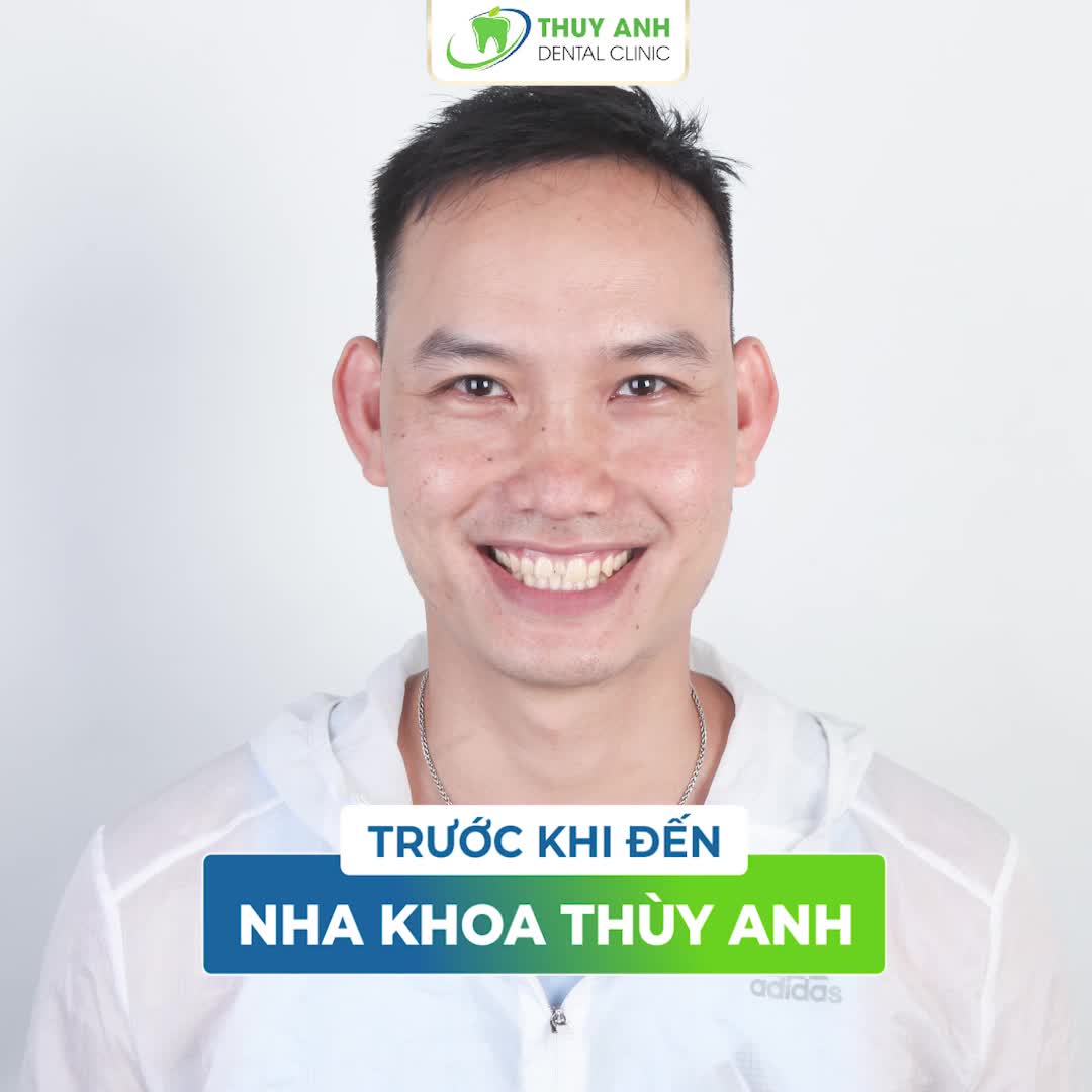 RĂNG SỨ THẾ HỆ MỚI - KHÔNG MÀI NHỎ RĂNG