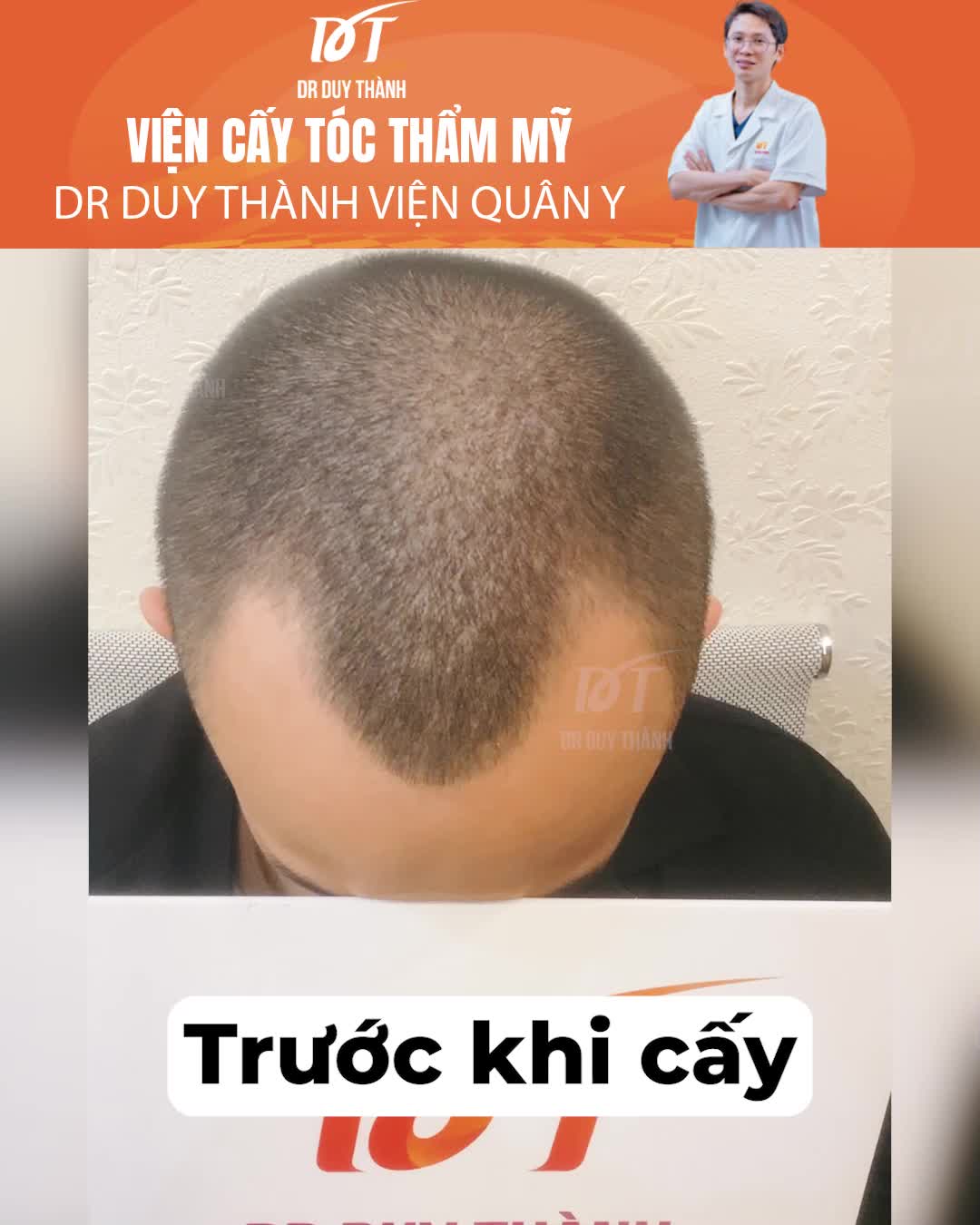 Thoát hói đẹp trai trở lại sau cấy 1300 nang tóc - Dr Duy Thành