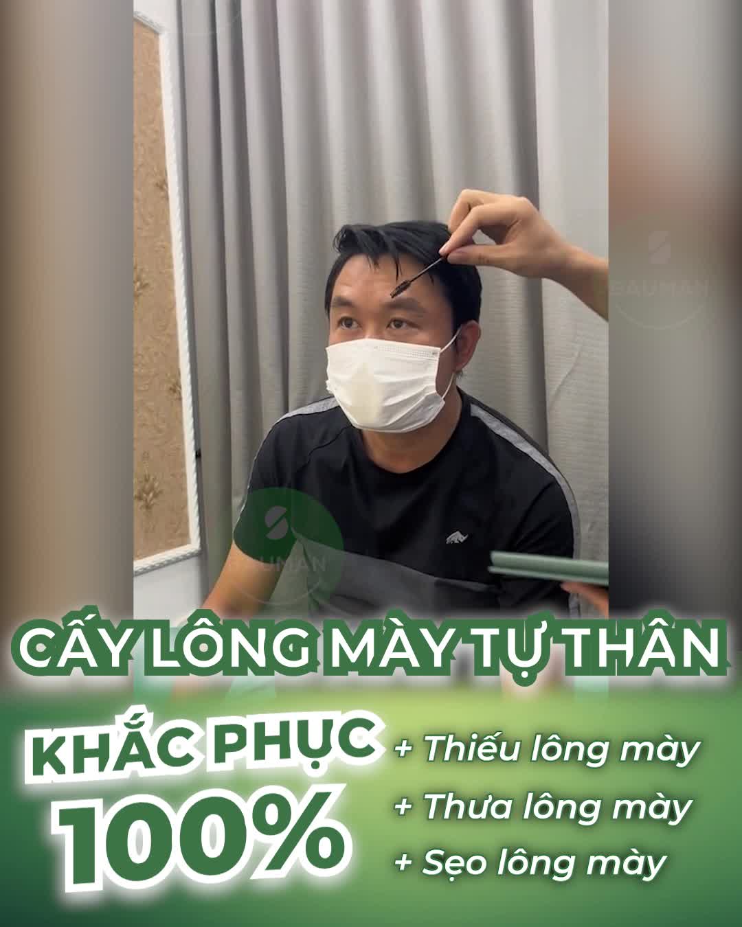 Cấy lông mày tự thân cho khách hàng nam bị mất đuôi lông mày (phần 2)
