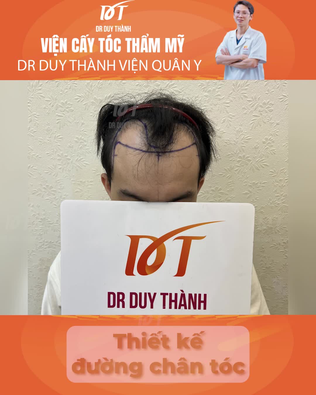 Bong vảy sau cấy 1800 nang tóc sẽ như thế nào?