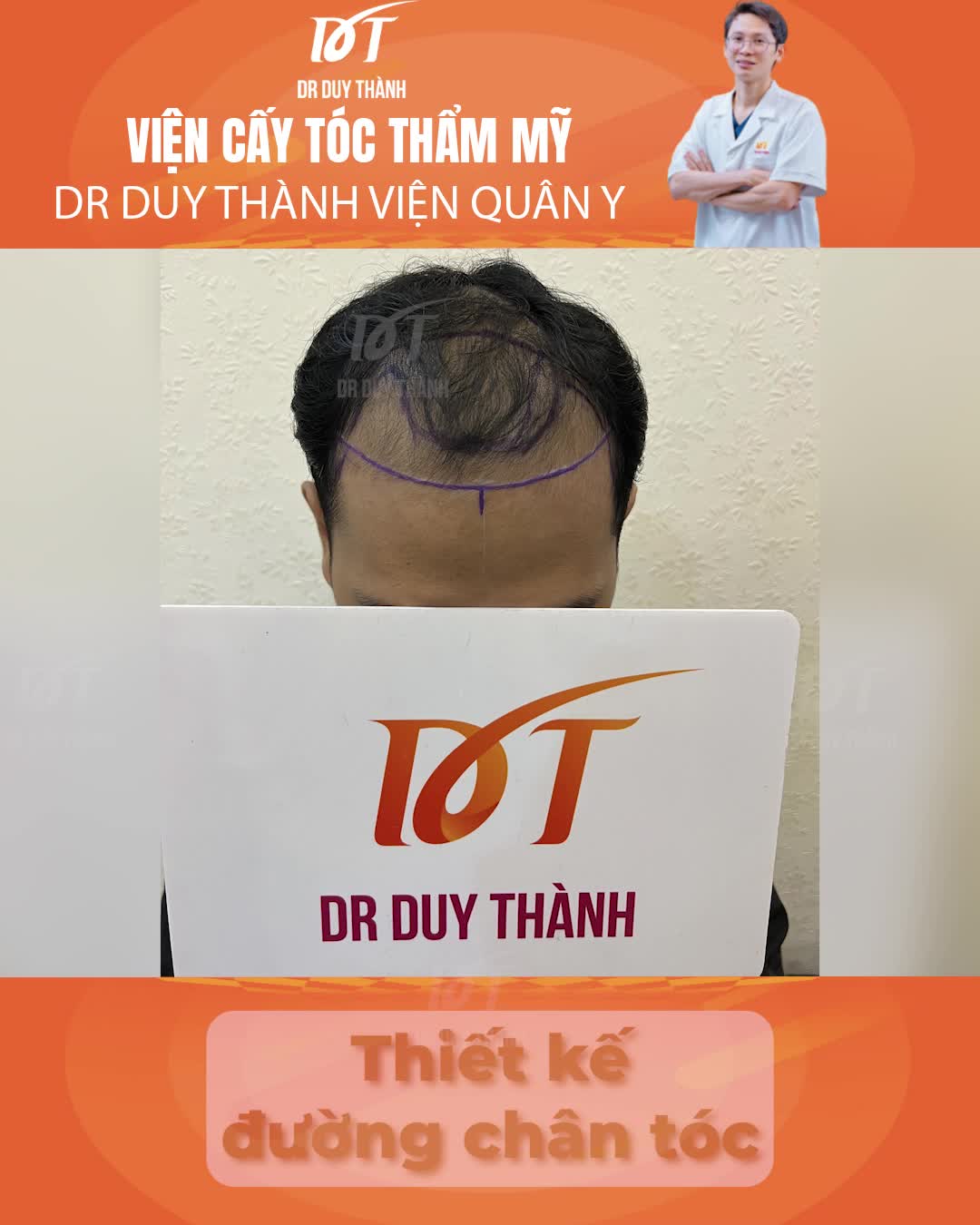 Cấy 2100 nang tóc kỹ thuật DHI chuyên sâu, sự khác biệt rõ nét ngay sau cấy