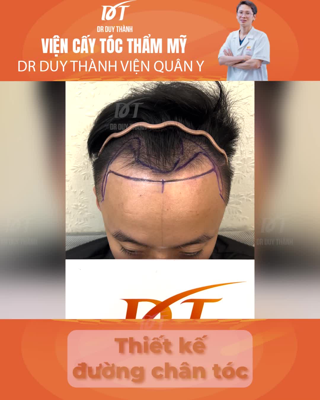 Tóc mọc tua tủa sau cấy 1900 nang tóc - Dr Duy Thành