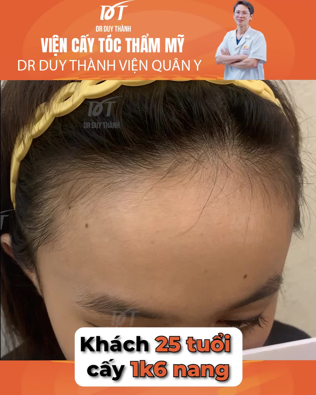 Đã xinh đẹp lại càng xinh đẹp hơn sau cấy tóc nữ - Dr Duy Thành