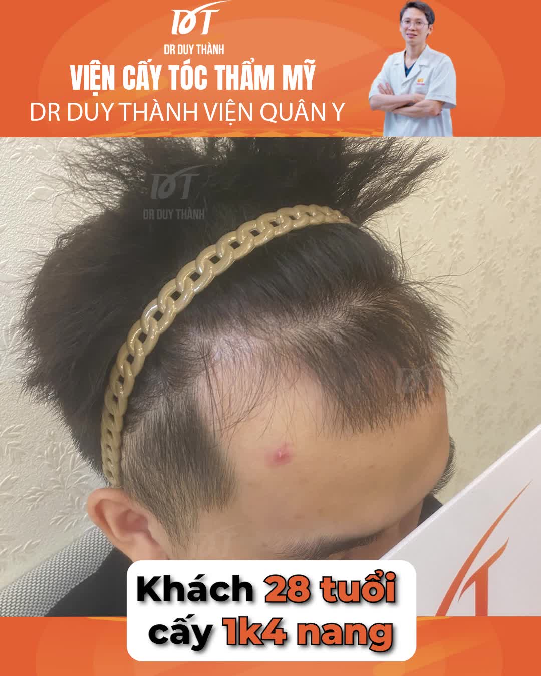 Cấy tóc 1400 nang, 4 tháng còn hoang mang và đến 6 tháng thì cái kết tuyệt vời