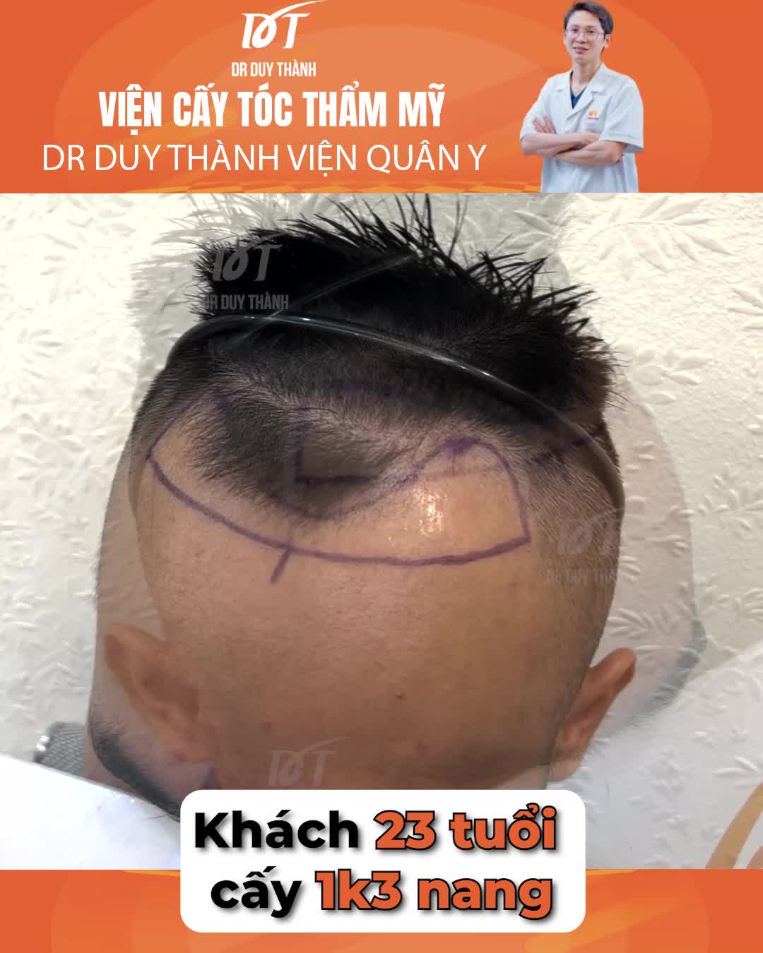 Cấy tóc 1300 nang hết hói chữ M - khách nam 24 tuổi Bắc Giang