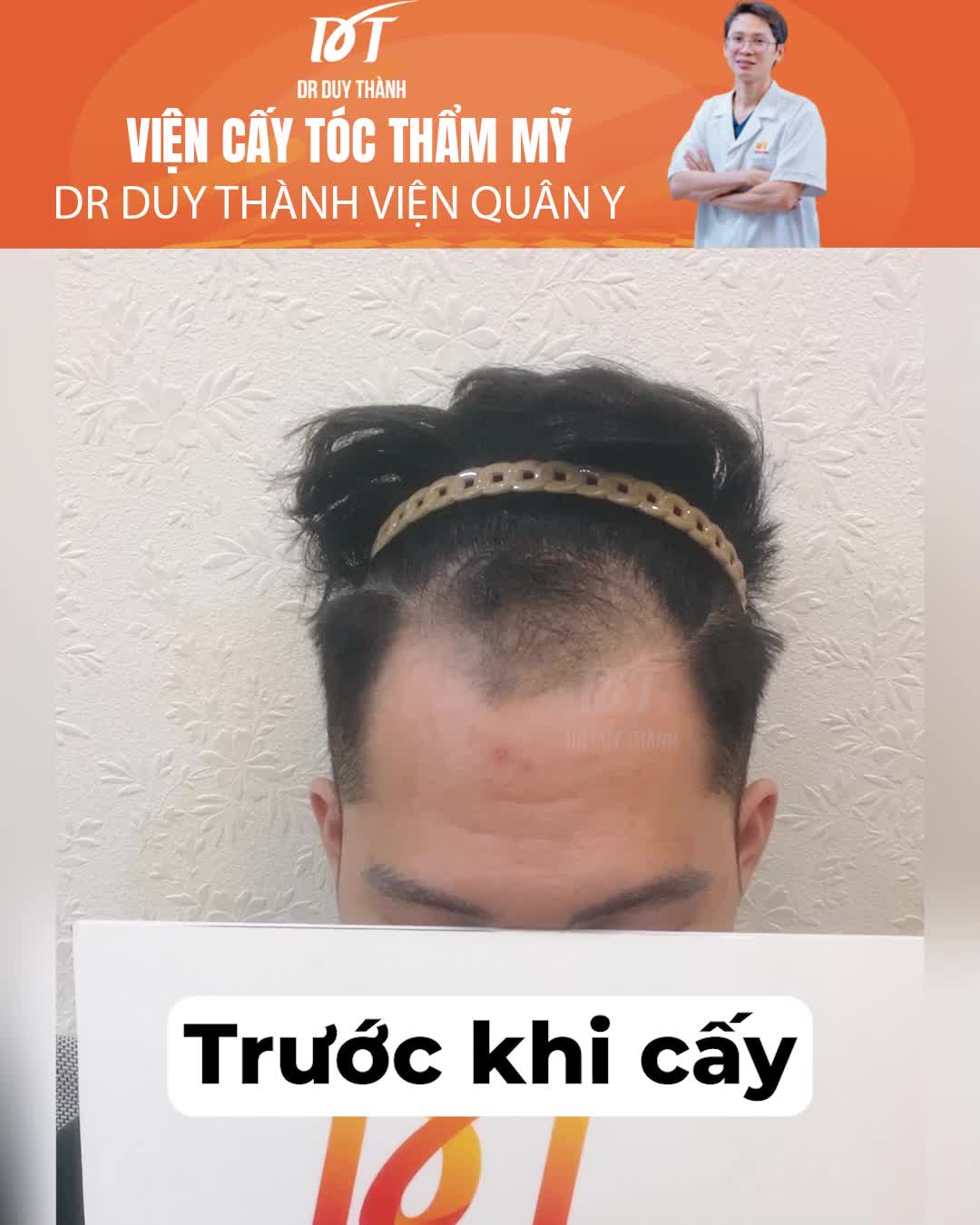 Cấy 1500 nang tóc sau 6 tháng - tóc mọc quá đen và dày
