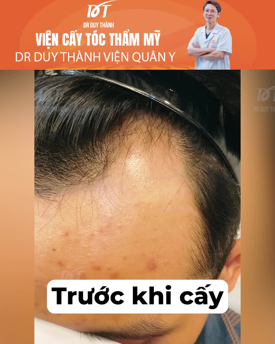 Cấy tóc tự thân 1325 nang, nam 30 tuổi, Vĩnh Phúc - kết quả sau 6 tháng