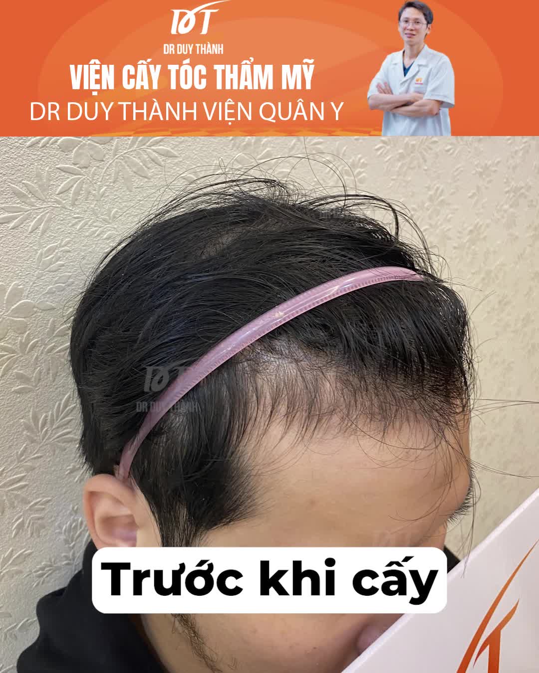 Hạ đường chân tóc, kết quả sau 6 tháng Hairline không thể tự nhiên hơn