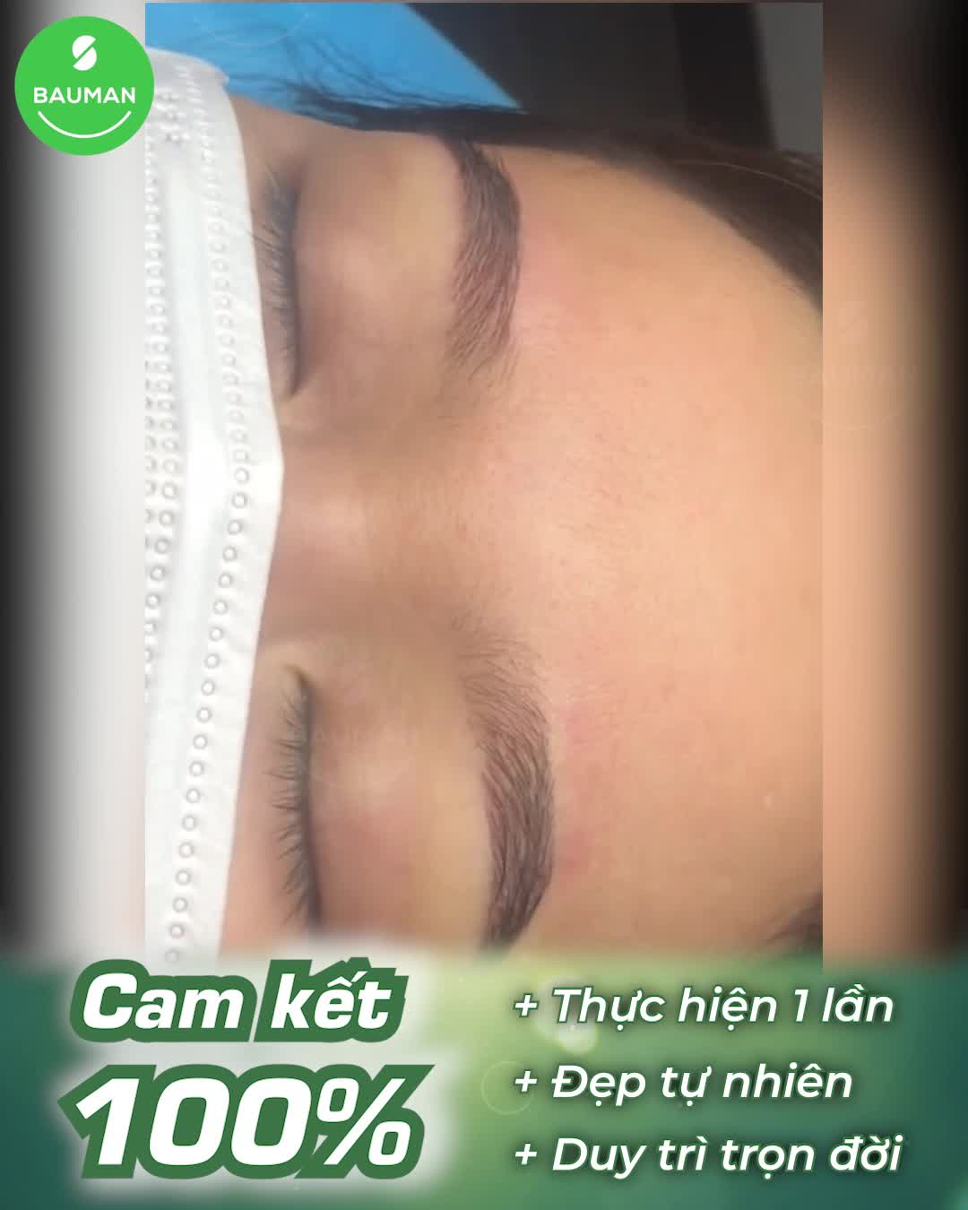 Biến hóa lông mày thưa thành lông mày dày dặn ngay sau cấy lông mày tự thân