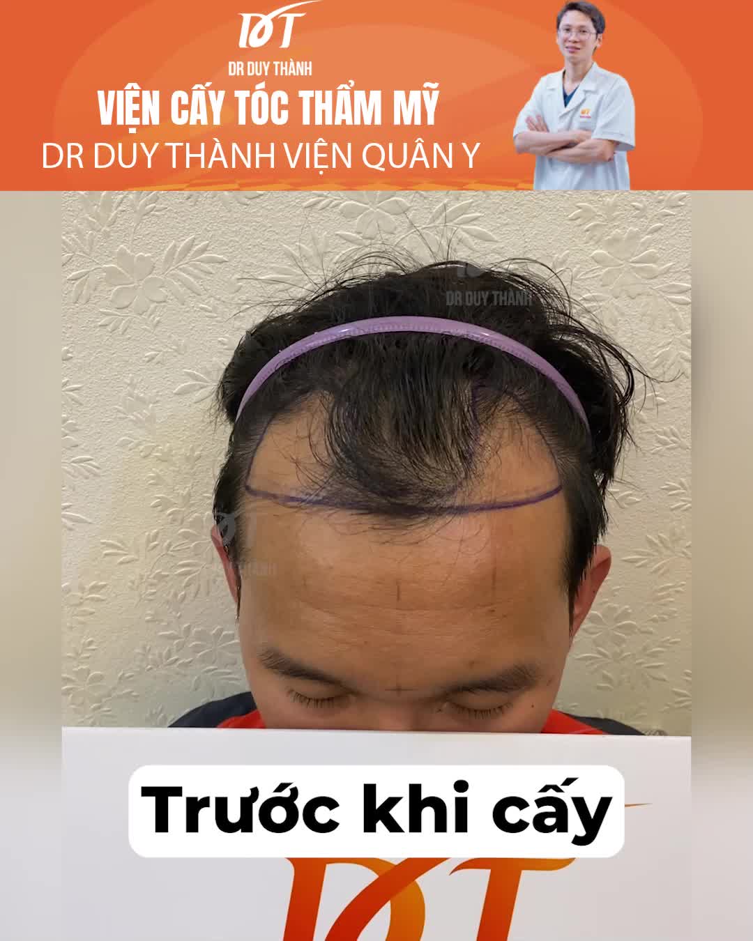 Anh em nào bị hói chữ M như này thì cấy tóc tự thân nhé, kết quả vĩnh viễn