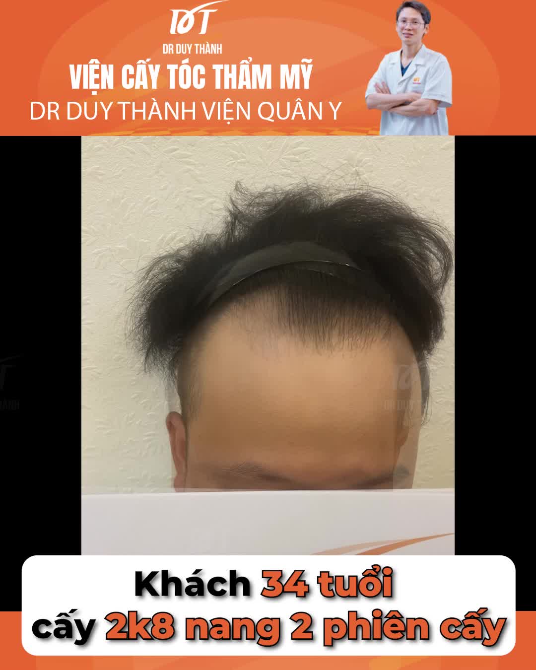 Cấy 2800 nang tóc và cái kết