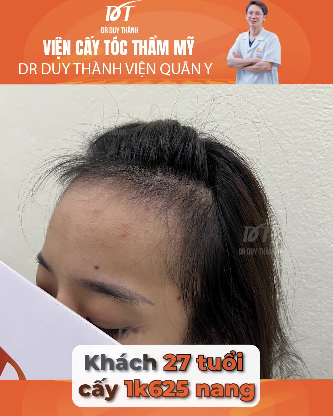 Cấy tóc nữ 1625 nang thu nhỏ trán, kết quả sau bong vảy