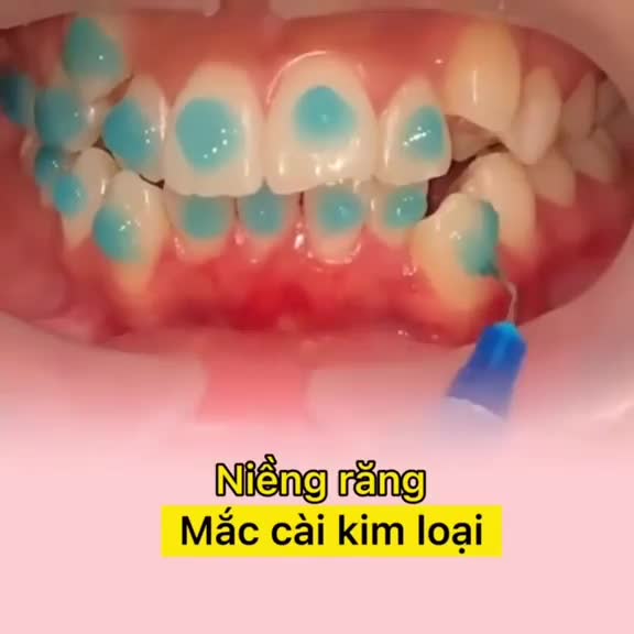 NIỀNG RĂNG MẮC CÀI - ĐỢI NGÀY ĐỔI KHÁC