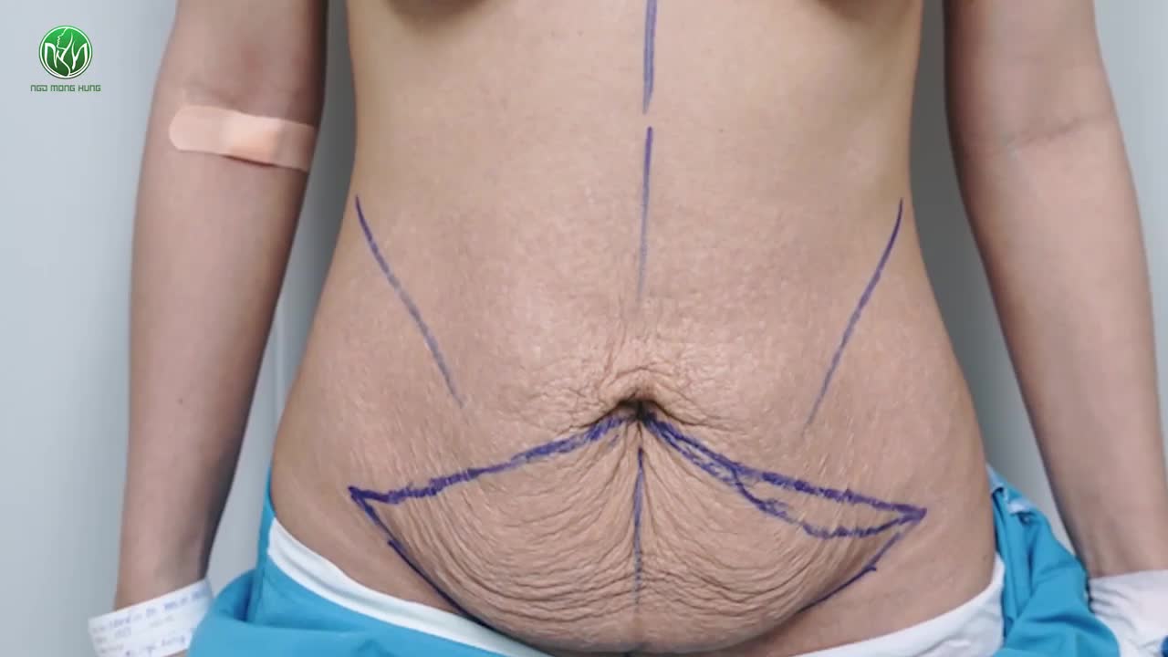COMBO NÂNG NGỰC - TẠO HÌNH THÀNH BỤNG CHO NỮ KH 30 TUỔI