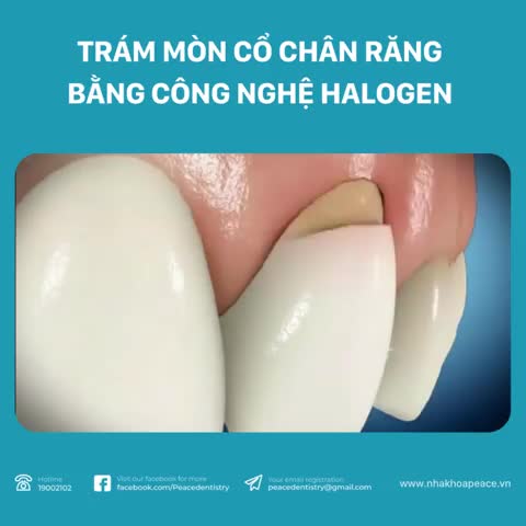 TRÁM MÒN CỔ CHÂN RĂNG THẨM MỸ VỚI VẬT LIỆU TRÁM COMPOSITE