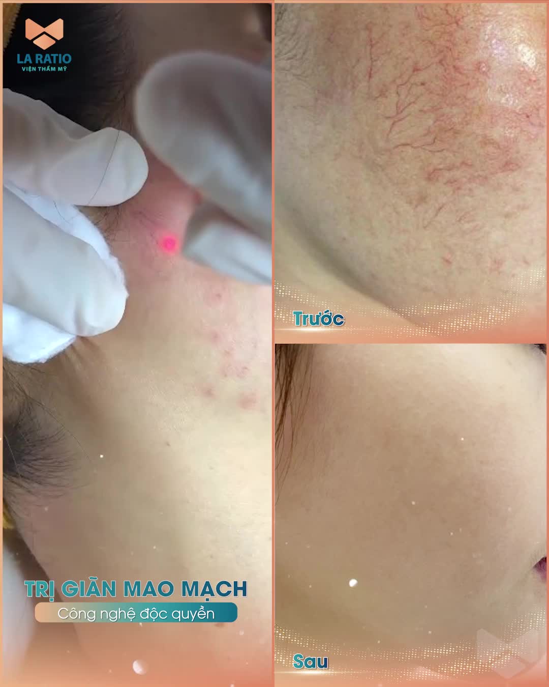 GIÃN MAO MẠCH Ở MẶT VÀ CÁCH ĐIỀU TRỊ