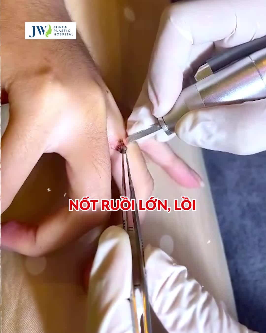 Chuyện lạ khó tin: Người phụ nữ XÓA NỐT RUỒI ở TAY vì KHÔNG THỂ ĐEO NHẪN CƯỚI và CÁI KẾT