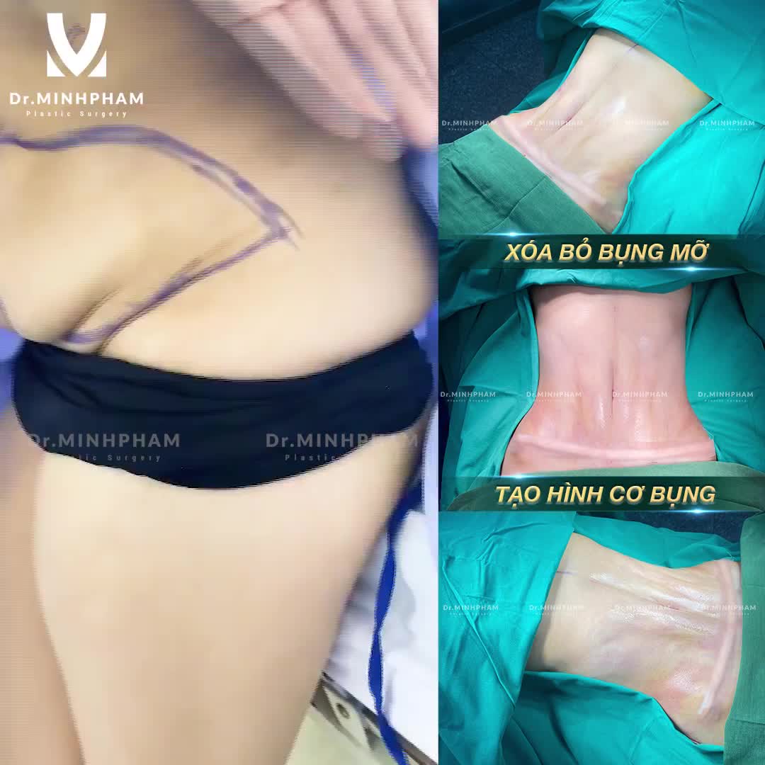 Bụng to, nhiều mỡ thừa Bụng xổ, sẹo mổ đẻ xấu xí Bụng chảy xệ, da nhăn rạn, chùng nhão