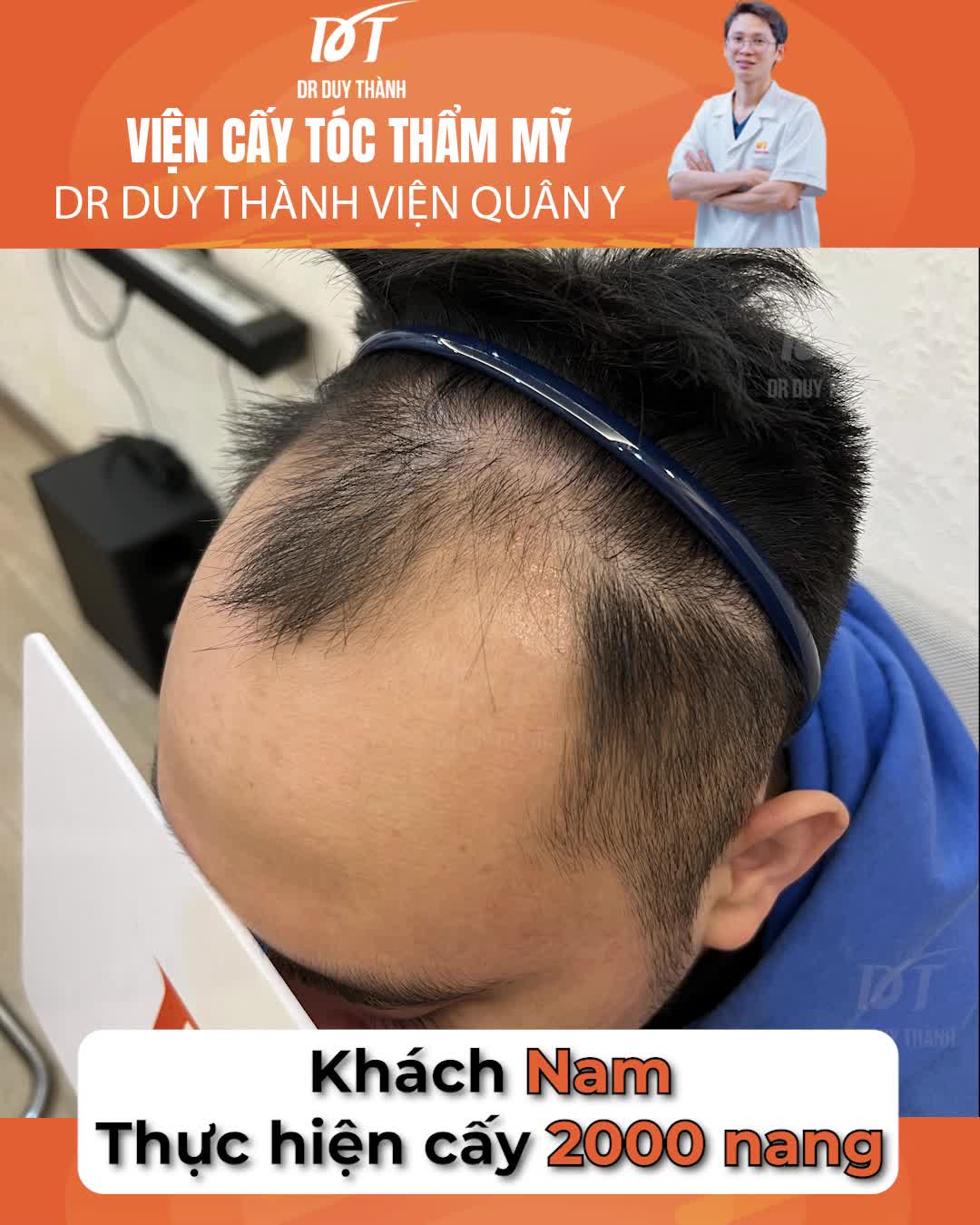 Cấy 2000 nang tóc khắc phục hói đầu, hãy xem cách anh ấy vuốt tóc
