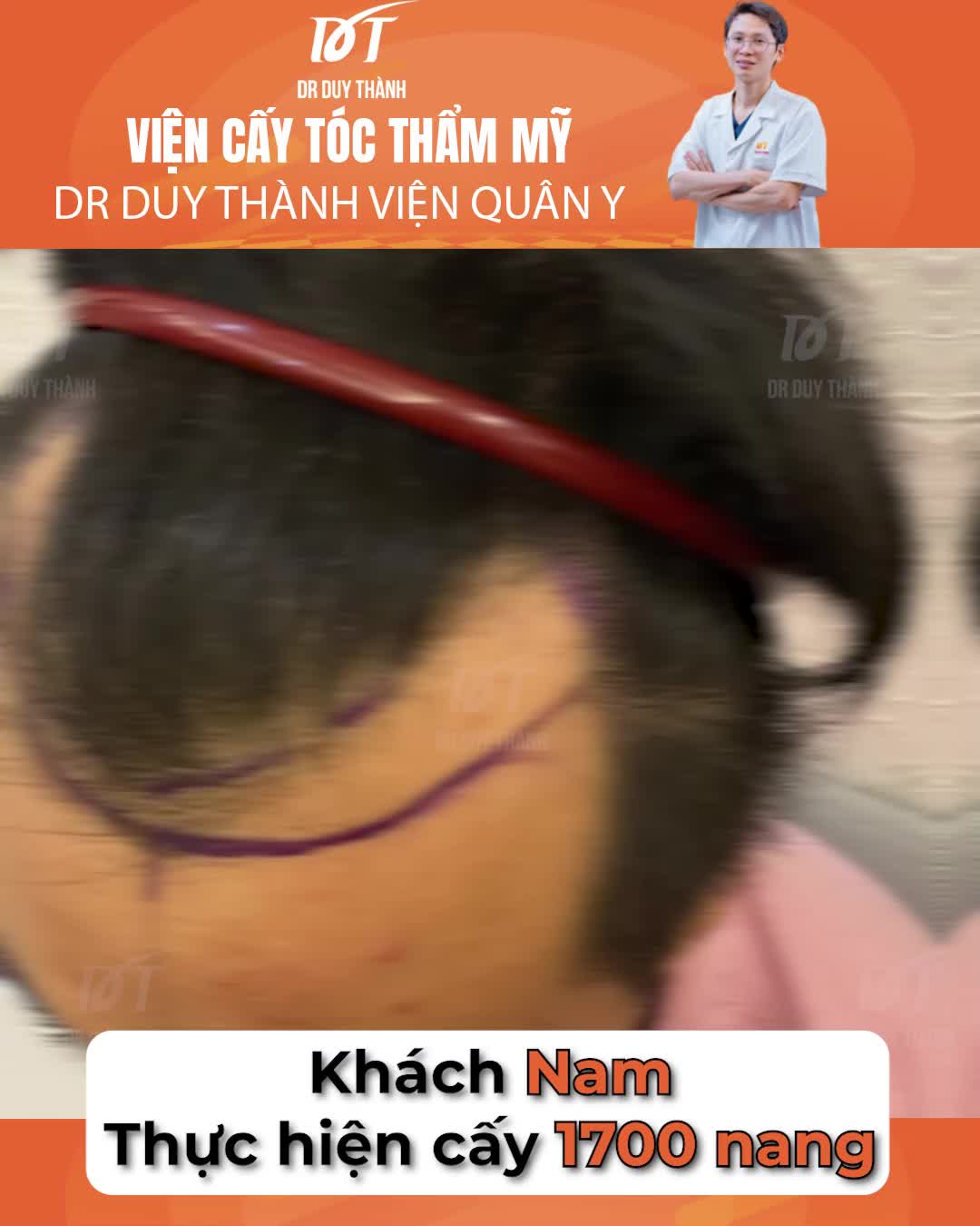 Cấy 1700 nang tóc phủ khuyết chữ M, khách nam 35 tuổi Nha Trang