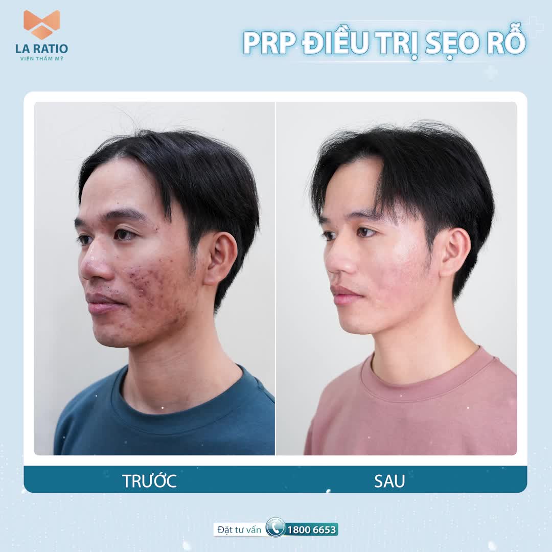 PRP - LIỆU PHÁP PHỤC HỒI LÀN DA HƯ TỔN