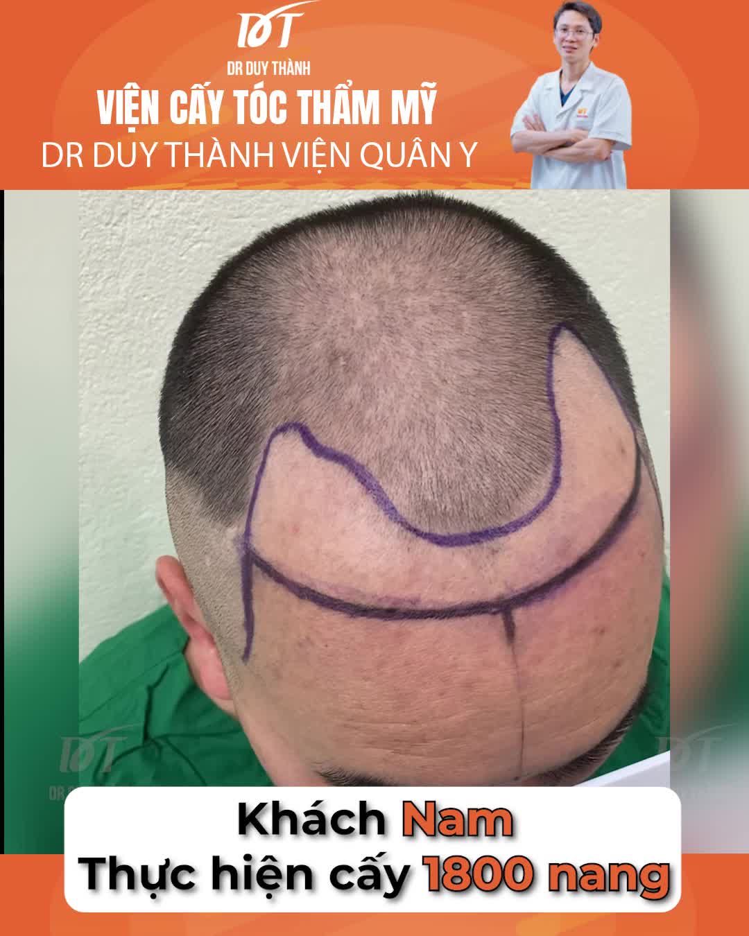 6 tháng sau cấy tóc, kết quả có tuyệt vời và tự nhiên không?