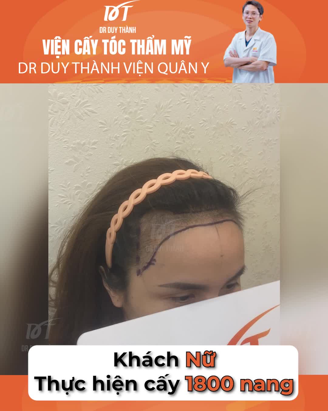 Cấy tóc nữ 1800 nang, khách hàng đã xăm chân tóc trước đó