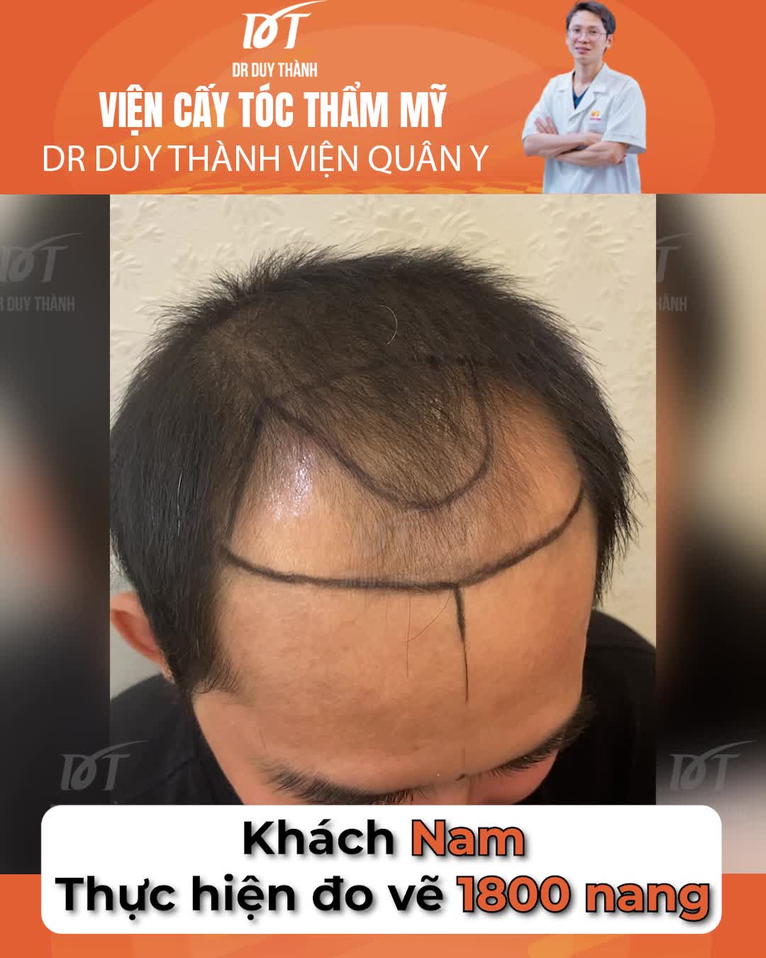 Cấy tóc tự thân 1800 nang đã thay đổi hoàn toàn một con người