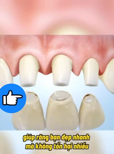 DÁN SỨ VENEER - KHÔNG MÀI NHỎ RĂNG THẬT