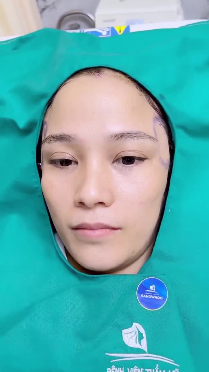 THĂNG HẠNG NHAN SẮC NHỜ PHƯƠNG PHÁP ĐỘN THÁI DƯƠNG TẠI BVTM GANGWHOO